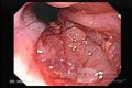 Gastric Cancer - Infiltration of Cardia