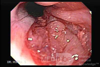 Gastric Cancer - Infiltration of Cardia