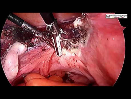 Difficult Total Laparoscopic Hysterectomy