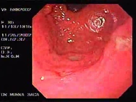 Multiple Gastric Ulcers - Assessment of the Antrum and Duodenum
