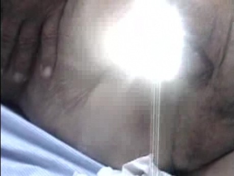 Recto-vaginal Fistula (3 of 3)