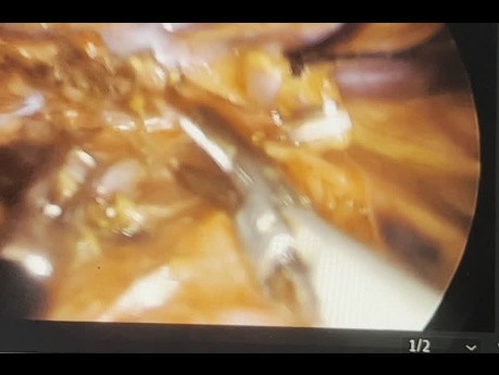 Thoracoscopic Esophageal Resection