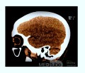 Acute Spontaneous Subdural Hemorrhage in the Subdural Space