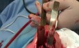 The Superior Rhinotomy For Inverting Papilloma
