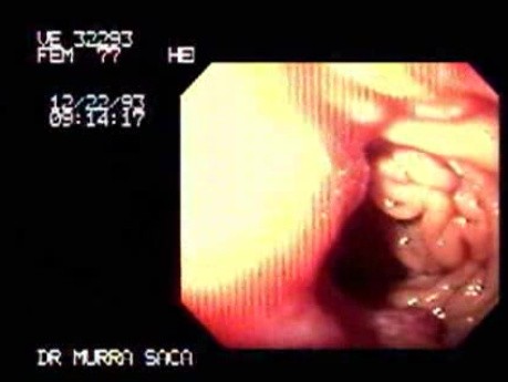 Pancreatic Cancer