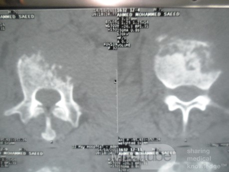 Pancreas cancer - 8