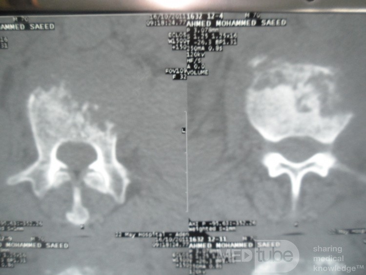 Pancreas cancer - 8
