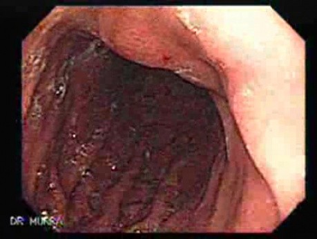 Adenocarcinoma with Signet Ring Cells (1 of 3)