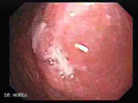 Systemic Lupus Erythematosus - Stomach finding (3 of 7)