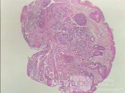 Gastric Carcinoid tumor (6 of 8)