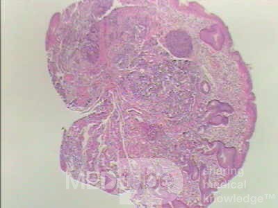 Gastric Carcinoid tumor (6 of 8)