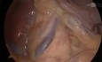 Arcuate Ligament Section