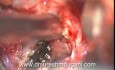 Colloid Cyst 3rd Ventrical - Trans Cortical, Trans Ventrical Microsurgical Total Excision