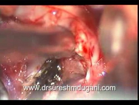 Colloid Cyst 3rd Ventrical - Trans Cortical, Trans Ventrical Microsurgical Total Excision