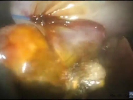 Evolution of Laparo-Endoscopic Single Site (LESS) Cholecystectomy Without General Anesthesia