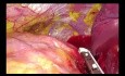 Uniportal VATS Subxiphoid Left Upper Trisegmentectomy (NON EDITED)