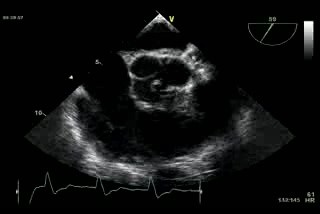 Biscupid Aortic Valve