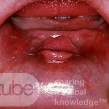 Denture Granuloma