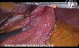 Laparoscopic Resection of Gastric GIST