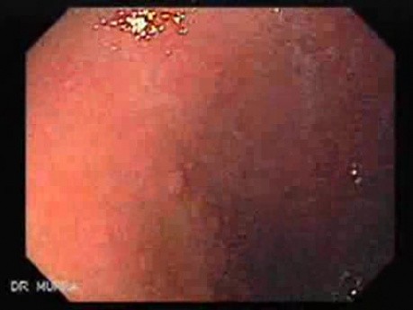 Gastric Cancer - Intestinal Metaplasia - Endoscopy (2 of 7)