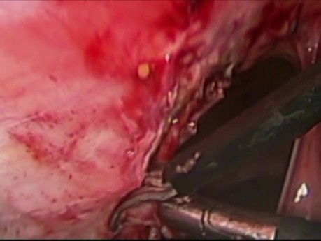 Endometriosis Located In The Thorax
