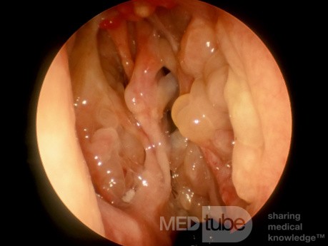 Recurrent Nasal Polyps
