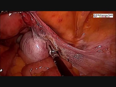 Bilateral Salpingo-oophorectomy for Ovarian Mass with Transvaginal Retrieval