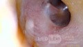 Dermoid Cyst - Comments?