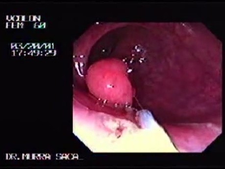 Endoscopic polypectomy (1 of 2)