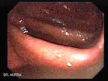 Massive Rectal Bleeding (6 of 11)