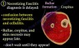 Necrotizing Fasciitis - Video Lecture - Part 2