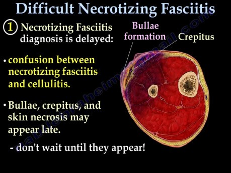 Necrotizing Fasciitis - Video Lecture - Part 2