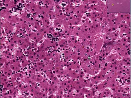 Erythroblastosis fetalis