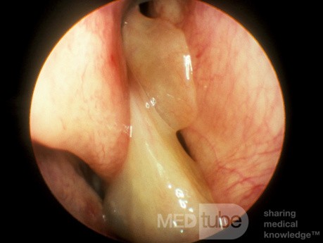 Nasal Polyps