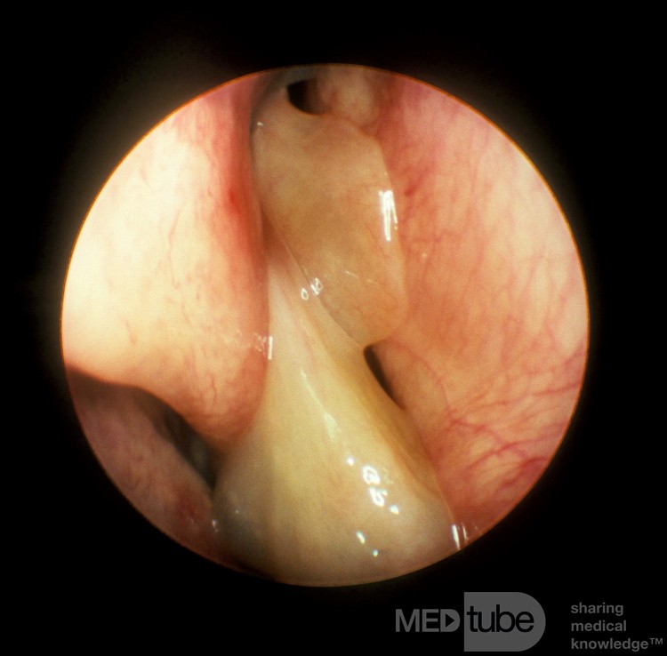 Nasal Polyps