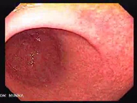 Gastric Antrum - High Resolution Videoendoscopy (6 of 8)