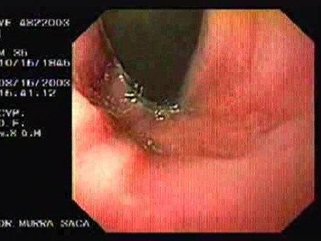 Flexible Endoscopic Suturing - 35 Years-Old Male