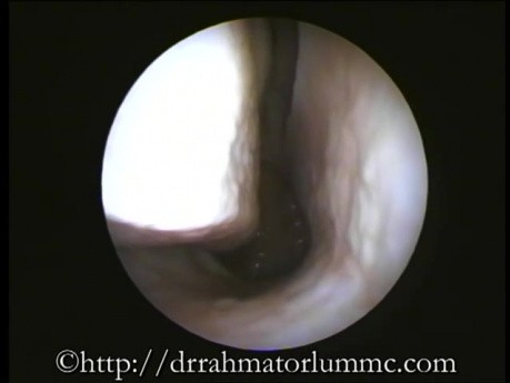 Normal Nasal Cavity - Endoscopic Examination