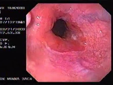 Banding of esophageal varices (1 of 17)