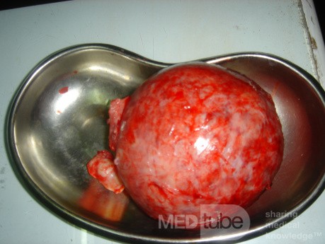 Myomectomy