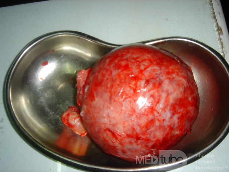 Myomectomy
