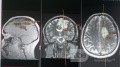Surgical Planning with Neuronavigator in Patient with Intracranial Mass Lesion. High Grade Glioma.
