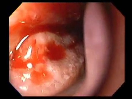 Severe Epistaxis - Case Study  (7 of 8)