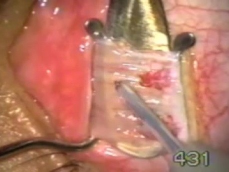 Bloodless Strabismus Surgery - Fugo Blade