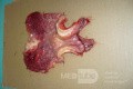 Endoscopy of Scirrhous Gastric Carcinoma involving the entire Fundus, Body and the Antrum (42 of 47)