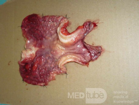 Endoscopy of Scirrhous Gastric Carcinoma involving the entire Fundus, Body and the Antrum (42 of 47)