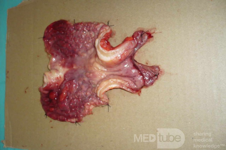 Endoscopy of Scirrhous Gastric Carcinoma involving the entire Fundus, Body and the Antrum (42 of 47)