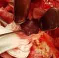 Total Resection of the Lesion Through a Lateral Fronto-Zygomatic Orbit Approach