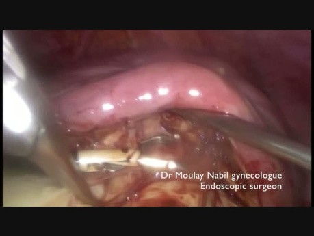 Laparoscopic Myomectomy, Hydrodissection Technique