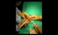 A Case of Torsion of Testes